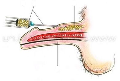 ін'єкційне збільшення пеніса